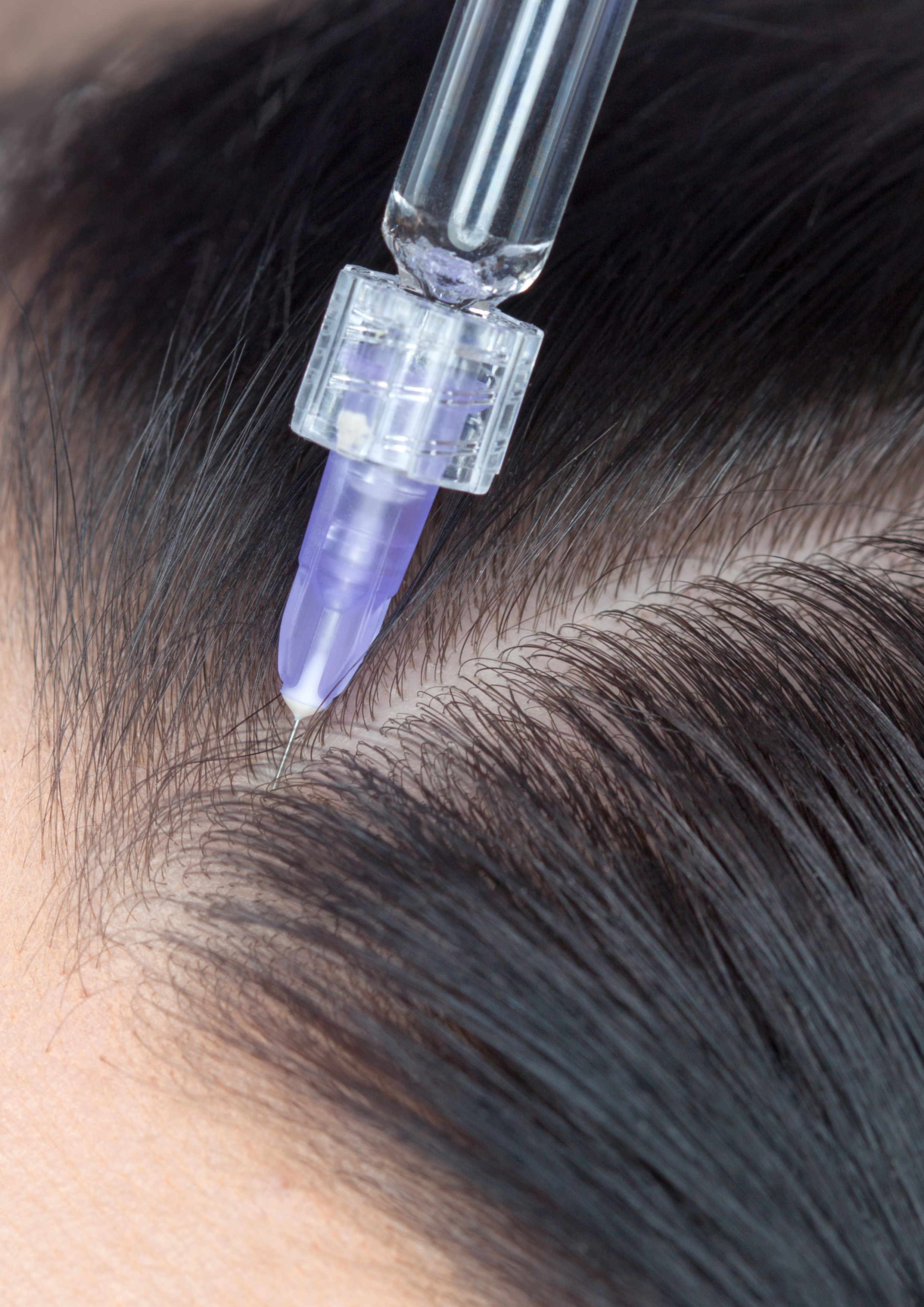 mésothérapie capillaire docteur dicharry la teste de Buch alopécie perte de cheveux médecine esthétique mésothérapie capillaire docteur dicharry la teste de Buch alopécie perte de cheveux médecine esthétique
