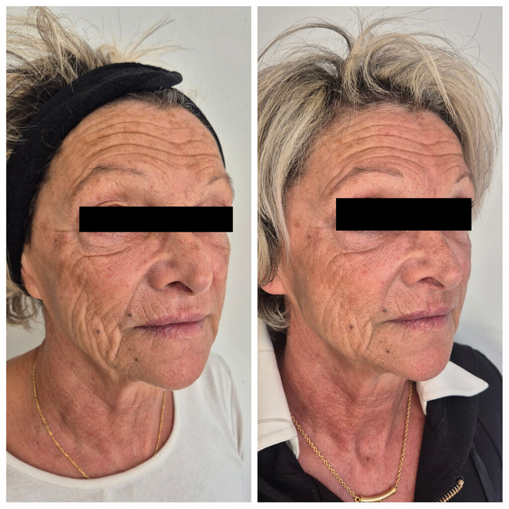 Avant apres radiesse visage 2